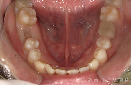 右下にフルジルコニアブリッジで修復