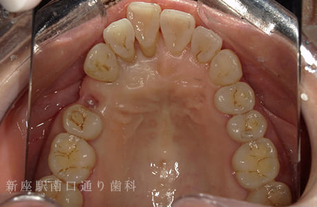 右上にフルジルコニアブリッジで修復術前