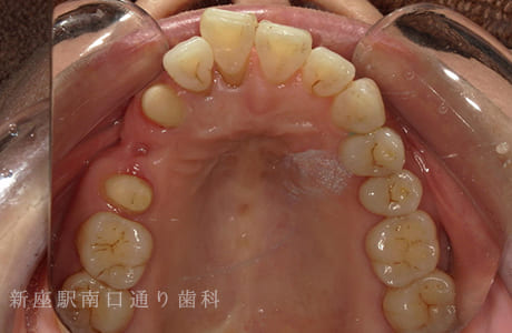 右上にフルジルコニアブリッジで修復術中