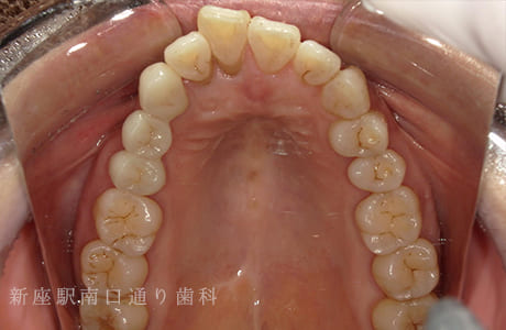 右上にフルジルコニアブリッジで修復術後