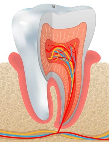 虫歯の最初期 C0（脱灰）