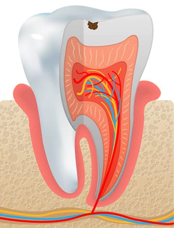 虫歯の初期 C1（歯の表面の虫歯・エナメル質）