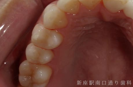 上顎術前セラミックe-maxインレー術後