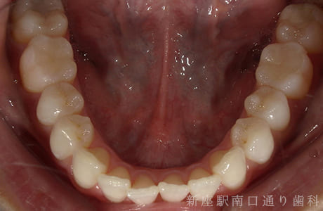 下顎術前セラミックe-maxインレー術後