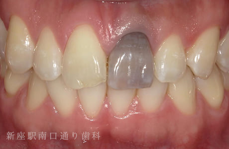 フルジルコニアセラミッククラウン術前