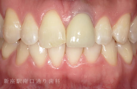 フルジルコニアセラミッククラウン術後