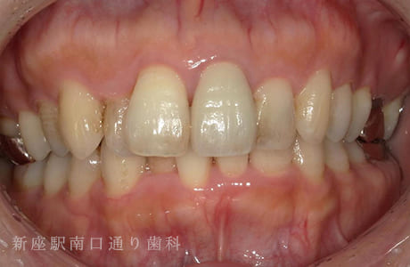 審美障害をジルコニアボンドセラミック術後