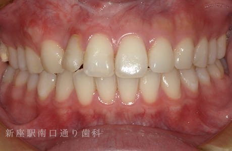 先天的欠損をジルコニア接着ブリッジ術後