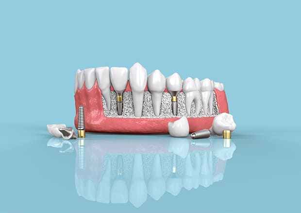 当院のインプラント治療の特徴