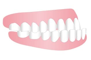 受け口、下顎前突、しゃくれ、反対咬合