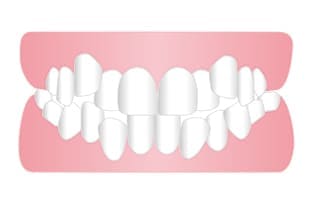 叢生、乱杭歯、八重歯