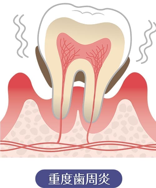 重度歯周病（食べ物を噛む力が弱くなる・顔貌が変わる）