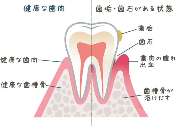 歯周病の予防について