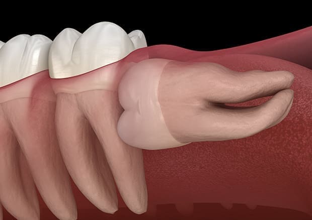 真っ直ぐ生えている親知らず